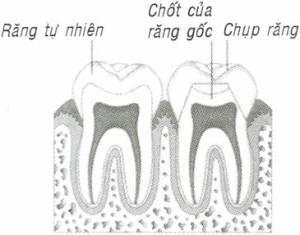Trồng răng sứ là phương pháp thay thế răng mất ưu việt nhất hiện nay vì nó đảm bảo được tính thẩm mỹ, chức năng ăn nhai và bảo tồn tối đa răng thật.